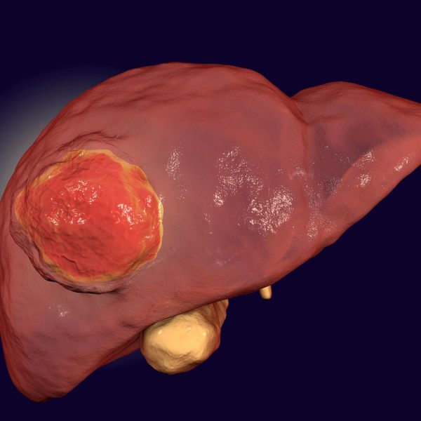 RNA Discovery May Lead to Better Diagnosis and Treatment of Liver Cancer